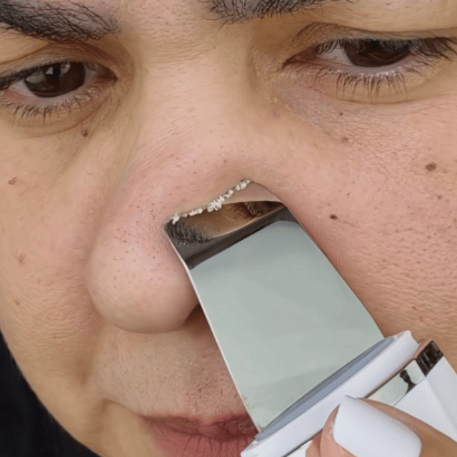 SoniqPeel™ El limpiador Facial peeling profesional que usas en casa